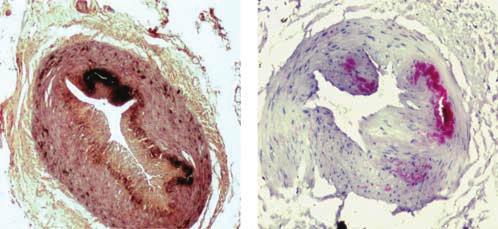 T Krueger et al.: deficiency in CKD patients mini review calcified aorta.