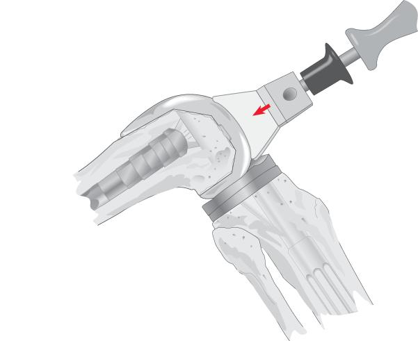Figure 26 Figure 27 Slide the femoral stem/sleeve impactor on top of the stem and forcefully apply three strikes with a mallet to engage the two component assemblies. (Figure 26).