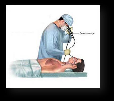 Bronchoalveolar lavage specimens: Bronchoalveolar lavage is a medical procedure in which a bronchoscope is passed through the mouth or the nose into the lungs and fluid squirted into a small part of