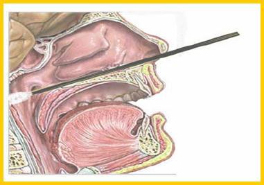 A nasopharyngeal swab should be inserted to reach the nasopharynx Nasopharyngeal sampling is an invasive process that can cause considerable distress to the patient.