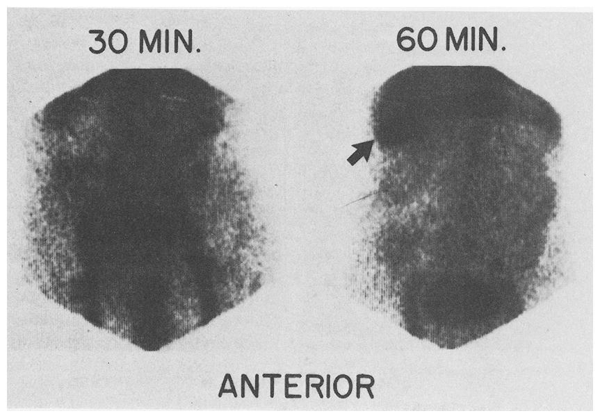for arteriography? (b) Can red blood cell scintigraphy reliably localize the site of bleeding so that it can be used to direct angiography or surgery, or both?
