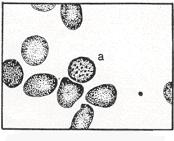 Figure 4-15. Variations in erythrocytes: (a) Basophilic stippled erythrocyte. (4) Heinz-Ehrlich bodies. These are small inclusions found primarily in those hemolytic anemias induced by toxins.
