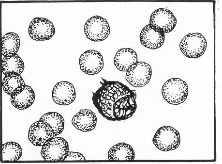 The stages of development are: plasmoblast, proplasmocyte, and plasmocyte. a. Plasmoblast. See figure 4-30. Figure 4-30. Plasmocytic series: Plasmoblast. (1) Size. 18 to 25 microns in diameter.