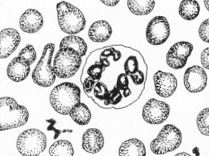 d. Basket Cell. A basket cell is a ruptured leukocyte that has a network appearance. These cells result from a partial breakdown of the immature and fragile leukocytes.