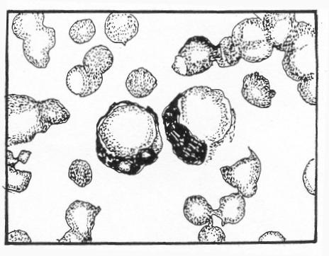 Often it is vacuolated which gives rise to a foamy appearance. h. L.E. Cells. See figure 4-36. Figure 4-36. Variations in leukocytes: L.E. cells.