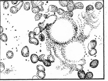 i. Rosettes. Rosette formation is the intermediate stage in the formation of an L.E. cell. A rosette formation consists of neutrophilic leukocytes surrounding free masses of lysed nuclear material. j.