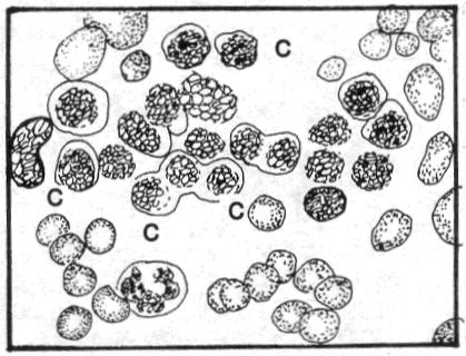 c. Rubricyte (Polychromatic Normoblast). See figure 4-3. Figure 4-3. Erythrocytes series: Rubricyte. (1) Size. 11 to 15 microns in diameter. N:C ratio 1:1. (2) Nucleus.