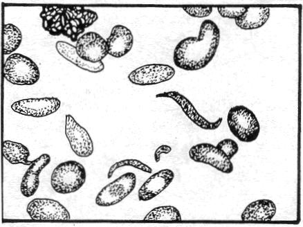 Figure 4-8. Variations in erythrocytes: Poikilocytosis: Sickle cells. (3) Spherocytes.