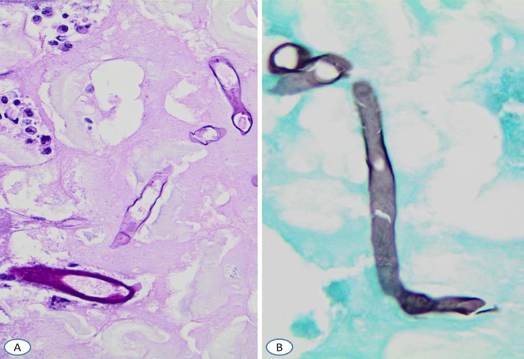 Boué J et al The Morphologic Identification of Common Organisms 232 Figure 6. Aseptate and wide Hyphae of Mucor (A) with H&E stain and (B) with GMS stain.