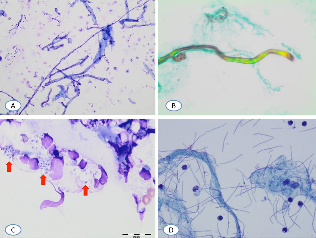 Ibnosina J Med BS 233 Figure 7. Synthetic Fibers on a Wright-Giemsa stained cytology specimen (A) and under polarizable light (B).
