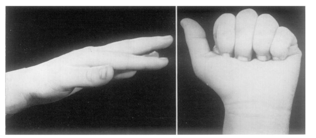 Examination at the time of operation (29th September 196o ) revealed mild rigidity in the medial joint and strong in the distal one. FIGS.