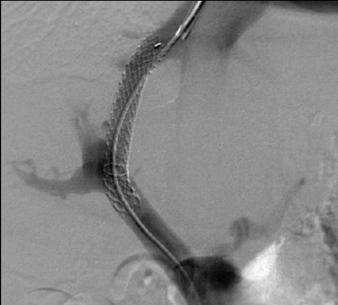 TIPS with Expanded Covered Stent Fig. 4 Kaplan-Meier analysis for survival. Mean expected survival was 21.9 months, with 59.3% cumulative overall survival at 24 months follow-up. A B C D Fig.