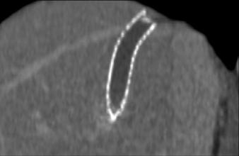 A D, Angiograms show success of transjugular intrahepatic portosystemic shunt (TIPS) procedure performed with Viatorr stent-graft (diameter, 10 mm; length, 80 mm; W. L. Gore and Associates) (A).