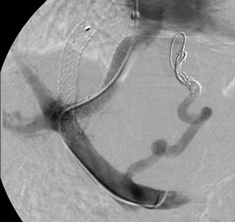 mm) followed by coil embolization of a large varix (D). Fig. 5 Kaplan-Meier analysis for survival grouped by Child-Pugh class.