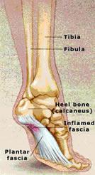 Plantar Fasciitis What is Plantar Fasciitis: Plantar Fasciitis is one of the most common causes of heel pain in Los Angeles and globally.