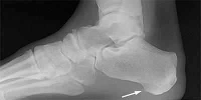 What is a Heel Spur and does it matter: A heel spur is extra bone on the bottom of the heel associated with the constant over pull of the plantar fascia on the heel.