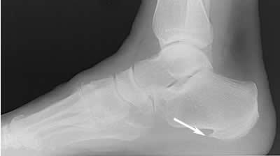 In the case of the plantar fascia, when the ligament is tight and on a constant stretch for many months and years a bone spur can grow in the area.