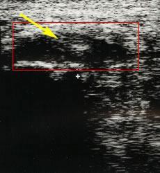 Thick fascia and spur noted on ultrasound (Thick