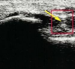 Partial fascia tear (Stretched fascia seen in box region with yellow arrow pointing to partial tear region) Plantar Fascitis Conservative Treatment Options: Conservative treatments will heal the