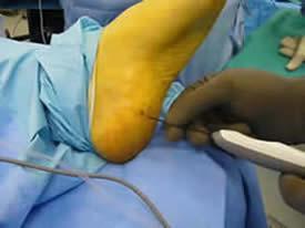 Fasciotomy Surgery: If all forms of care fail including Topaz minimally invasive surgery, a fascia release surgery is used to