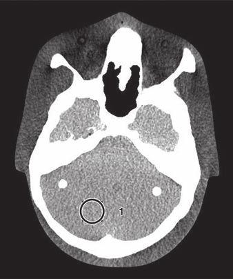 Lens Dose in Head CT A Fig. 3 CT images show selected ROIs for measurement of image noise and contrast. A, ROI 1 is in region of right cerebellum.