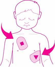 Pediatric-Pak continued After Using the samaritan PAD ANTERIOR-LATERAL PLACEMENT If a child s chest is large enough to permit a 1 in/2.