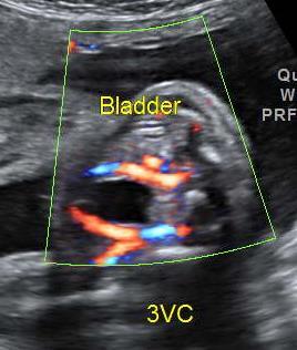 Bladder Normal Appearance Central position in fetal pelvis Anterior to rectum Thin walled No internal