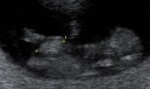 Normal Gut Herniation Fetuses have exompholos at 9-10 weeks