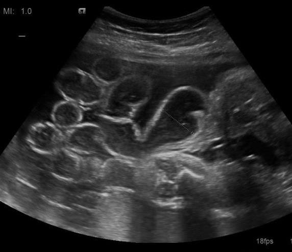 Gastroschisis Normal cord insertion defect below and to right of cord