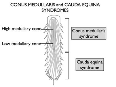 affected Sparing of motor CONUS MEDULLARIS Spinal level, skeletal injuries T10 L2 Lesions affecting lower sacral segments of