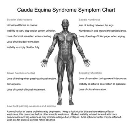 CAUDA EQUINA SYNDROME Lumbo-sacral nerve root injury: L2 and caudal Pain BLE polyradicular distribution No spinal cord involvement Usually incomplete injury Asymmetric Motor weakness Areflexic bowel