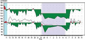 5: Masked Hypertension Night Avg : 131 /80 ; Day Avg : 131/82; % Dip : 0.1 % Fig.