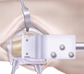 Step 5: Osteotomy Guide Placement 5-1 Place the First Choice Modular Ulnar Head osteotomy guide on the last reamer used.
