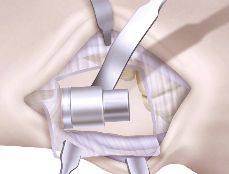 Using a sagittal saw with the blade held flush against the surface of the osteotomy guide, cut to the level of the reamer.