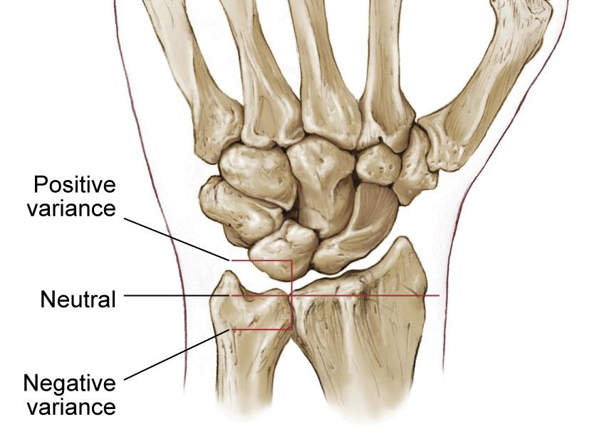 Note the presence and magnitude of any ulnar variance.