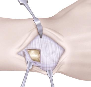 TFCC and the ECU sheath. Leave a small rim of capsule attached to the sigmoid notch to facilitate ease of closure.