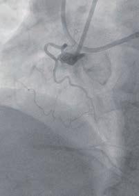 Application of the hybrid approach in a right coronary artery chronic total occlusion