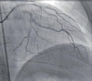 (A) Coronary angiography demonstrating a chronic total occlusion of the proximal right
