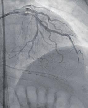 (B) Dual coronary injection demonstrating filling of the right posterior descending
