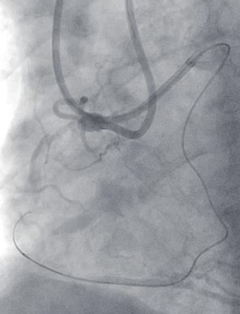 (F) Unsuccessful attempt for antegrade crossing using the CrossBoss catheter