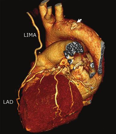 Evaluation of Ascending Aortic Atherosclerosis with 16-Multidetector Computed Tomography Feuchtner et al the left femoral artery.