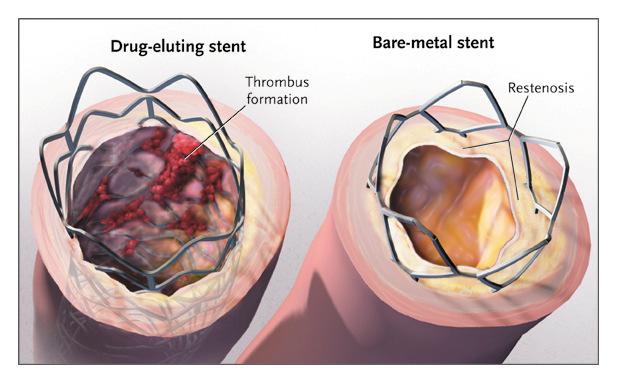 Bare-metal stents may be narrowed or obstructed by ingrowth of tissue.