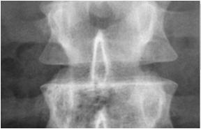 Crushed blockhead think malignancy. Malignancy is only a diagnosis if no other signs of infection or trauma. Vertebral body should NEVER be the same height as pedicles. Square Blockhead System (cont.