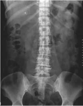 AP lumbar view Motive=Routine Scout. Step 1. Start at lower 1/3 of SI joint. 3 conditions come to mind AS (ankylosing spondylitis, benign sclerosis of bilat SIJ), DJD, OCI (Osteitis condensans ilii).