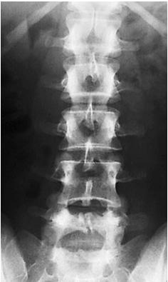 Count down lumbar spine checking for lumbosacral transitional segment. If you count 6 lumbar vertebra = lumbarization of S1.
