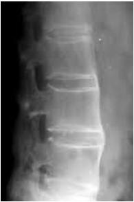 drippings of Diffuse Idiopathic Skeletal