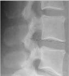 Increased disc angle (severe wedging) anteriorly. may be seen in acute or chronic conditions. Thin discs is when one disc is thinner than discs above and below. Indicates a chronic condition.