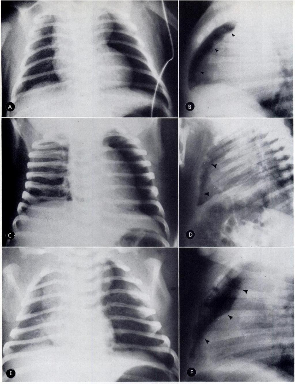 - :.Th -:, -, Fig. 1 -Large, hyperlucent hemithorax sign with sharp ipsilateral mediastinal edge showing varying degrees of abnormality.