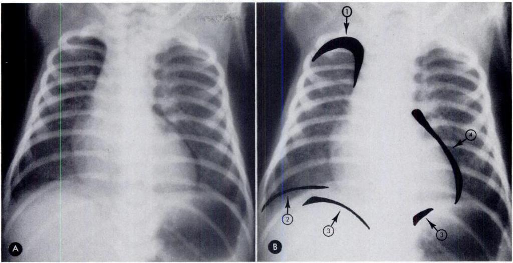 . NEONATAL PNEUMOTHORAX 625 Fig. 2.-Cloaking of the lung sign at various locations. A. Supine view of infant with respiratory distress.
