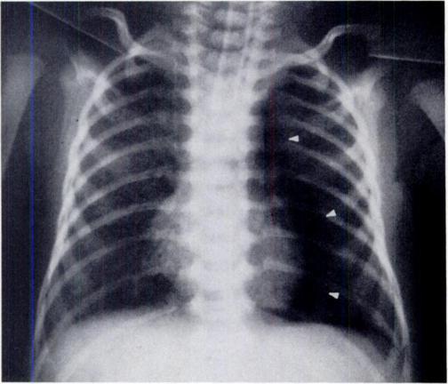 This is medial stripe sign of medial pneumothorax. B, Diagrammatic representation of free air locations seen in part A. 1, Over apex of lung; 2.
